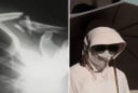 Một phụ nữ bị gãy xương do thói quen che nắng cẩn thận quá mức