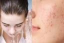5 thói quen khiến lỗ chân lông to ra mà bạn không ngờ tới