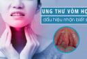 7 dấu hiệu K vòm họng: Số 1 không biết sớm khó mà chữa