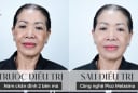 Pico Melasma - Bước tiến công nghệ vượt bậc giúp LG Clinic vươn tầm trong lĩnh vực điều trị nám da