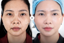 Căng da không phẫu thuật -Công nghệ 5.5.10: Vì sao trở thành xu hướng trẻ hóa được phụ nữ sau 40 tuổi lựa chọn?