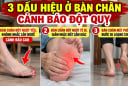 3 dấu hiệu ở bàn chân cảnh báo đột quỵ, số 1 cảnh báo cao