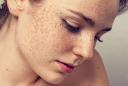4 liệu pháp để loại bỏ nám da hữu hiệu nhất hiện nay