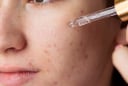 Da mụn dùng retinol như thế nào?