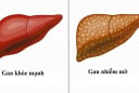 Gan nhiễm mỡ có gây ung thư gan? Chuyên gia cảnh báo dấu hiệu cần biết sớm