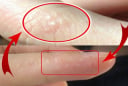 Tay mọc mụn nước li ti có sao không?