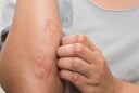 ５dấu hiệu cảnh báo bạn đang mắc bệnh thận giai đoạn nặng: Có 1 cũng nên đi khám sớm