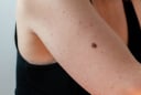 Cảnh báo: Đốm nhỏ trên da có thể là dấu hiệu ung thư – Đừng chủ quan