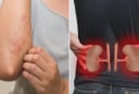 Cơ thể có 7 dấu hiệu này, cảnh báo bệnh thận, suy thận đang đến gần