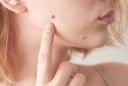 3 vị trí mọc nốt ruồi dễ thành ung thư da: Cảnh báo đừng xem thường