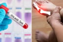 8 cách đơn giản giúp đào thải axit uric ra khỏi cơ thể, phòng ngừa bệnh gout