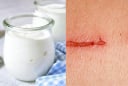 Nghiên cứu mới: Làm Gel trị thương từ sữa chua