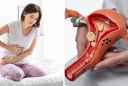 Dấu hiểu cảnh báo K cổ tử cung sớm: Phụ Nữ u 40 đang khoẻ mạnh cũng chớ xem thường