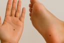 6 vị trí nốt ruồi dễ biến đổi thành ung thư: Đừng chủ quan bỏ qua