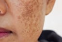 Cảnh báo ung thư: 5 vùng cơ thể đổi màu đen, dấu hiệu sớm nhiều người bỏ qua