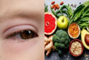 Mắt xuất hiện 3 dấu hiệu bất thường, coi chừng cholesterol trong máu quá cao: Khi rửa mặt nhất định phải chú ý