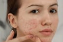 5 tác hại khi không rửa mặt sau khi đắp mặt nạ mà nhiều người không ngờ tới