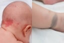 Cảnh báo: Những dấu hiệu 'nốt ruồi son - bớt - vết chàm' trên trẻ có thể tiềm ẩn nguy cơ bệnh lý