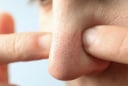 5 mẹo đơn giản đánh bay mụn đầu đen giúp da nàng láng mịn
