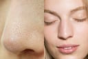 Ghim ngay 3 tips trị mụn cám vừa rẻ vừa hiệu quả chẳng tốn tiền đi spa