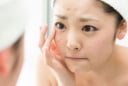Mẹo nhỏ giúp bạn lấy lại làn da sạch mụn chỉ sau một đêm
