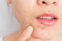Nếu còn mắc 4 sai lầm này hàng ngày da bạn sẽ càng nổi nhiều mụn