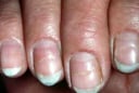 5 dấu hiệu bất thường trên móng tay cảnh báo ung thư: Đừng chủ quan kẻo phát hiện quá muộn