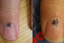 Cảnh báo sức khỏe: 6 bộ phận màu đen thường báo hiệu nguy cơ ung thư, đừng chủ quan!