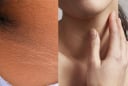 Nhìn thấy dấu hiệu này trên da, cẩn thận Tiểu Đường tới gần