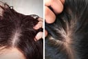 4 cách trị gàu tự nhiên giúp 'đánh bay' nỗi lo về mái tóc nhiều gàu