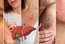 Da xuất hiện 5 dấu hiệu này, đừng chủ quan: Gan có thể đang “kêu cứu”