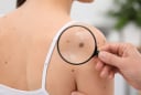  5 dấu hiệu bất thường trên da có thể cảnh báo nguy cơ ung thư: đừng chủ quan