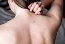 Cải thiện mụn lưng và da sần sùi tại nhà: Routine đơn giản giúp da body mịn màng rõ rệt