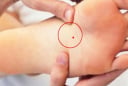 4 nốt ruồi vùng kín mang lại may mắn: Đừng dại xóa đi