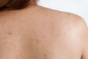 Mụn lưng bùng phát vào mùa hè: Những cách chăm sóc giúp da cơ thể thông thoáng hơn