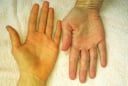 6 dấu hiệu trên cơ thể cảnh báo gan của bạn đang kêu cứu: Nên đi khám gấp