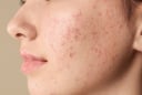 5 cách giúp giảm mụn cám tại nhà, hỗ trợ da thông thoáng và mịn màng hơn