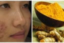 Cách trị sẹo tại nhà đơn giản, giúp da mịn màng hơn mỗi ngày