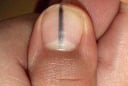 5 dấu hiệu trên móng tay cảnh báo bệnh nan y: Có 1 trong 5 dấu hiệu cũng nên đi khám gấp