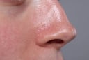 Da dầu mụn có cần dưỡng ẩm không? Nhiều người đang mắc sai lầm khiến mụn ngày càng nghiêm trọng