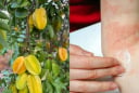  Mách mẹo làm giảm rôm sảy, mẩn ngứa bằng lá khế: Dân gian dùng nhiều nhưng cần biết đúng cách