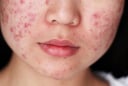 Căng thẳng kéo dài có thể khiến mụn trứng cá dai dẳng và khó kiểm soát