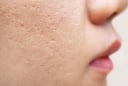 3 lầm tưởng phổ biến về điều trị sẹo mụn khiến nhiều người tốn thời gian mà hiệu quả không như mong đợi