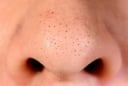6 thói quen khiến mụn đầu đen dai dẳng hơn, nhiều người vẫn mắc phải mỗi ngày