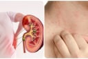 3 dấu hiệu cảnh báo suy thận giai đoạn nặng