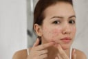 7 loại mặt nạ thiên nhiên hỗ trợ làm mờ thâm mụn, giúp da sáng khỏe tại nhà