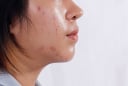 4 thói quen khiến da dầu dễ nổi mụn hơn mỗi ngày, nhiều người vẫn vô tình mắc phải