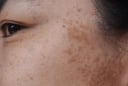 5 thói quen hằng ngày âm thầm khiến làn da dễ bị nám, nhiều người vẫn lặp lại mà không hay biết