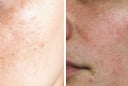 3 nguyên tắc chăm sóc da giúp cải thiện nám sau sinh và lấy lại làn da sáng khỏe
