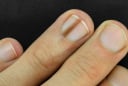 Những dấu hiệu bất thường ở móng tay cảnh báo bệnh nguy hiểm